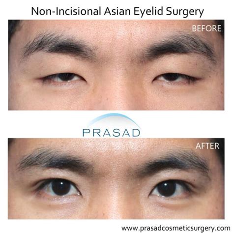 china crease eye supplier